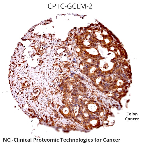 IHC of Human Colon Cancer labeled with DSHB antibody against Glutamate-Cysteine Ligase Regulatory Subunit. Image credit: NCI-Clinical Proteomic Technologies for Cancer